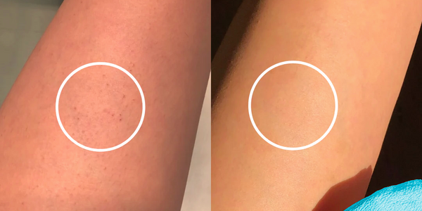 Effective Ways to Treat Keratosis (Chicken Skin)