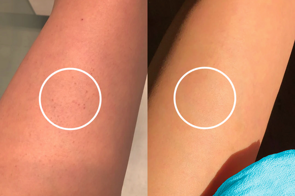 Effective Ways to Treat Keratosis (Chicken Skin)