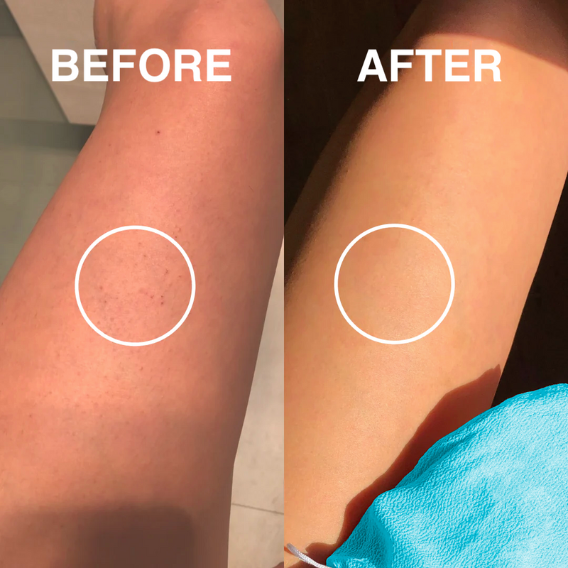 Effective Ways to Treat Keratosis (Chicken Skin)